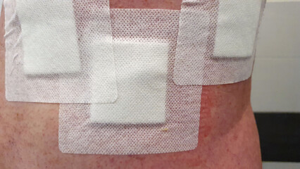 Postoperative Back With Dressings, Scars and Stitches