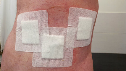 Postoperative Back With Dressings, Scars and Stitches