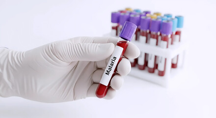 Medical Doctor Hand Holding Blood Test Tube Sample for Malaria Diagnosis in Laboratory