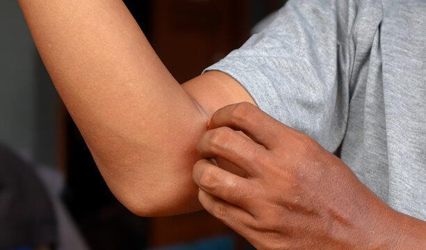Young asian man itching and scratching on arm from itchy dry skin eczema dermatitis. Skin disease. Dermatological care. 