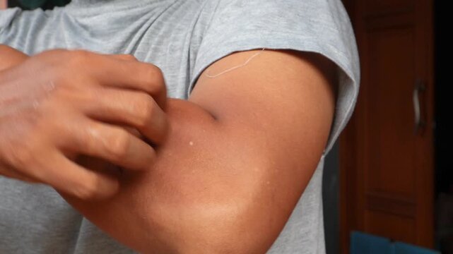 Young asian man itching and scratching on arm from itchy dry skin eczema dermatitis. Skin disease. Dermatological care. 