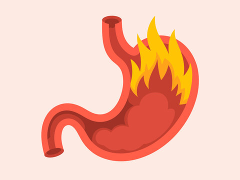 This graphic visually represents a stomach ablaze with flames, symbolizing heartburn or acid reflux, bringing awareness to digestive health and related discomfort.