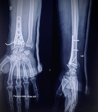 Postoperative X-Ray of Distal Radius Fracture with Volar Locking Plate and K-Wire Fixation in Forearm and Wrist