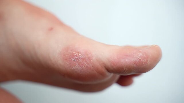 Strong reaction of human body on chronic stress or allergy, acute symptom of psoriasis, dyshidrotic eczema or atopic eczema, redness, itchy dry and peeling skin of human toes, infected epidermis being