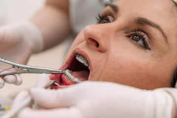 Close up of Orthodontist hands working on female dental braces in dental clinic