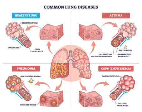 Healthy lung diagram shows lungs, alveoli, and bronchiole with comparisons to asthma, pneumonia, and COPD, explaining airway health at a glance. Outline diagram