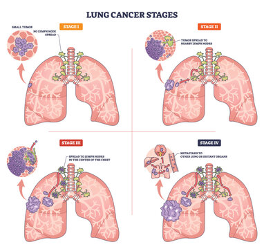 Lung cancer stages presented in a brief medical graphic, lungs, tumors, and lymph nodes show progression from Stage I to IV with metastasis. Outline diagram