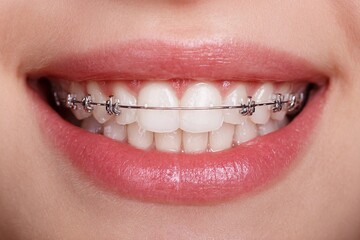 Obraz premium Smiling teenager shows braces in close-up dental care moment at home