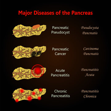 Major Diseases of the Pancreas, early signs of pancreatic cancer