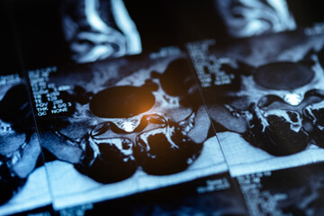 Mri scan of spinal column showing disc protrusion, Cause of pinched sciatic nerve in leg buttock