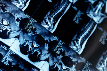 Mri scan of spine showing lumbar disc protrusion in cross-sectional view