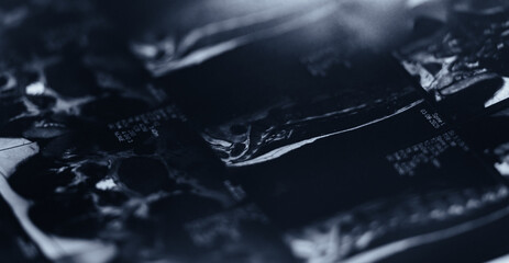 Mri scan of human spine with disc protrusion visible in lateral view