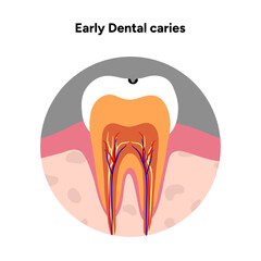 Hand-drawn dental infographic illustrating tooth anatomy and stages of cavity development. Educational medical illustration showing enamel, dentin, pulp, plaque, and decay progression