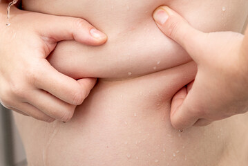 Fototapeta premium Skin fat fold woman body, concept obesity, unhealthy lifestyle and lose weight