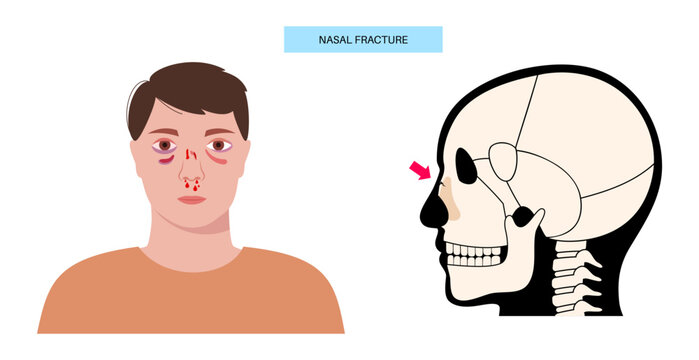 Nasal fracture poster