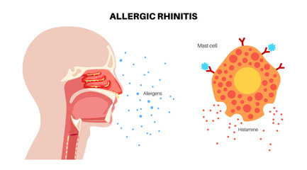 Allergic rhinitis poster