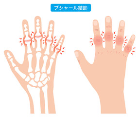 ブシャール結節　指の関節の病気