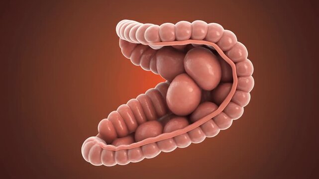Colon Polyps - Understanding Growth and Potential Risks in the Intestine.