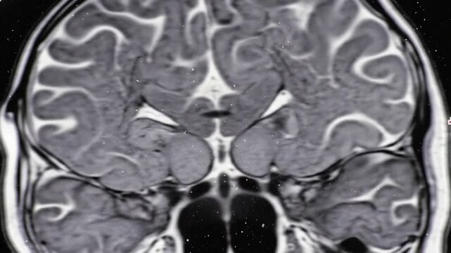 Detailed coronal brain MRI scan highlighting cerebral structures, anatomical details, and white spots throughout the image on a black background.