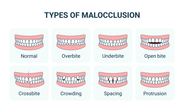 Types of Malocclusion and Normal Human Teeth, Frontal View. Vector Medical Infographic, Editable Outline.