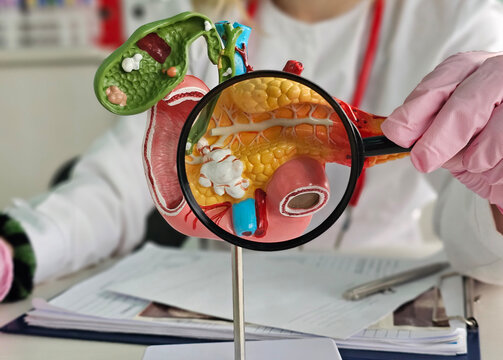Anatomical model of the pancreas, duodenum, and spleen. Diseases and treatments for liver, spleen, and pancreas lesions concept