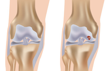 Detailed medical illustration comparing a healthy human knee joint with a joint affected by an articular cartilage lesion. Diagram of Knee Osteochondral Defect. Cartilage Damage