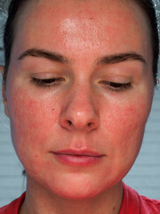 the patient's face after the micro needle RF lifting procedure. Restoration and regeneration of the skin after cosmetology