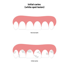 Hand-drawn dental infographic illustrating initial caries white spot lesion. Shows enamel demineralization, tooth layers, enamel surface changes, and early-stage decay. 