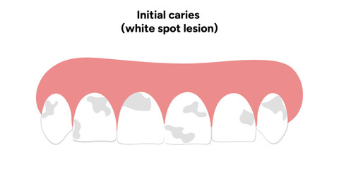 Hand-drawn dental infographic illustrating initial caries white spot lesion. Shows enamel demineralization, tooth layers, enamel surface changes, and early-stage decay. 