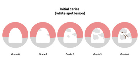 Hand-drawn dental infographic illustrating initial caries white spot lesion. Shows enamel demineralization, tooth layers, enamel surface changes, and early-stage decay. 