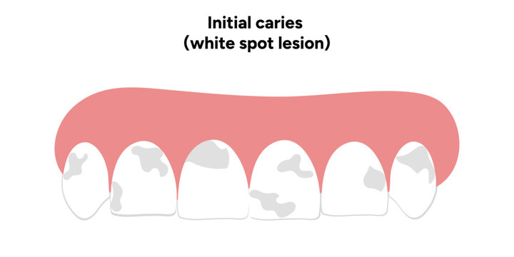 Hand-drawn dental infographic illustrating initial caries white spot lesion. Shows enamel demineralization, tooth layers, enamel surface changes, and early-stage decay. 