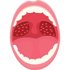 Open Mouth Showing Red Tonsils And Sore Throat Medical Illustration