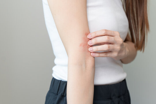 Sensitive skin allergic concept, Woman itching on her arm have a red rash from allergy symptom and from scratching.
