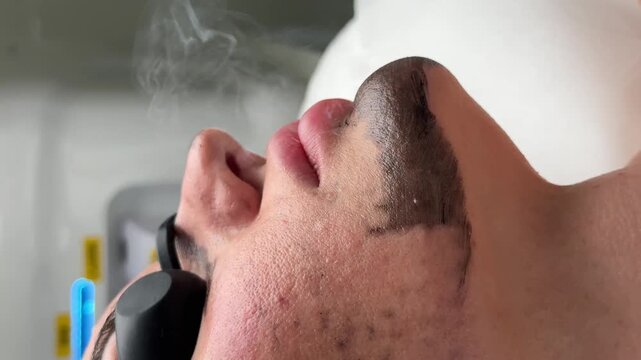 Young woman getting carbon laser facial at beauty clinic. Professional skincare treatment for deep pore cleansing, acne reduction and skin rejuvenation. Modern cosmetology procedure.