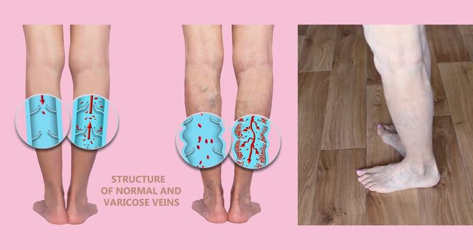 Varicose veins on a female senior legs. The structure of normal and varicose veins. Concept of dry skin, old senior people, varicose veins and deep vein thrombosis or DVT - 2D animation