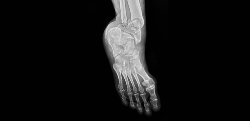 Ankle and foot x-ray showing tibia, fibula, talus and tarsal bones. Lateral view radiograph for...