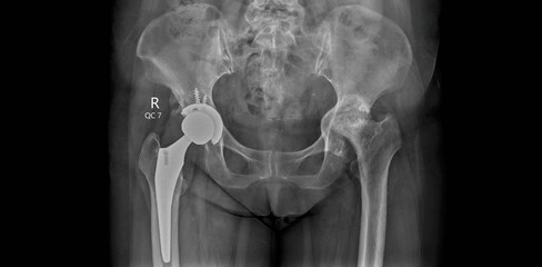 Pelvic x-ray showing hip replacement prosthesis. AP radiograph for postoperative examination of...