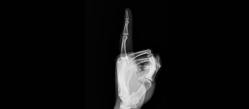 Hand x-ray showing finger bones and joints in pointing position. Radiograph for diagnostic examination of hand anatomy, phalanges and finger skeletal structure