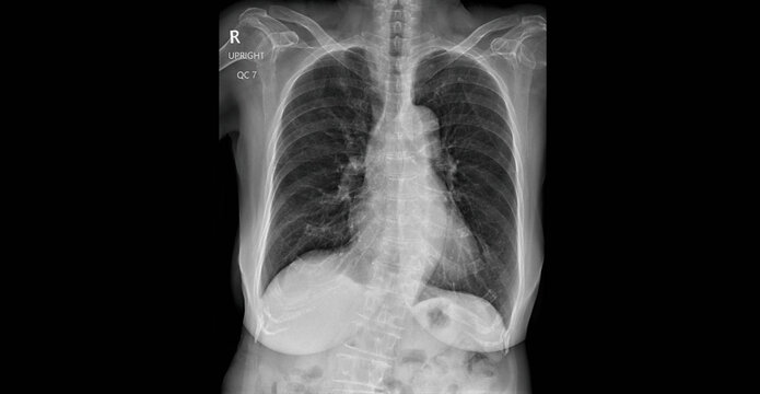 Chest x-ray showing lungs, heart and thoracic cavity. Upright AP radiograph for diagnostic examination of respiratory system, mediastinum and chest anatomy