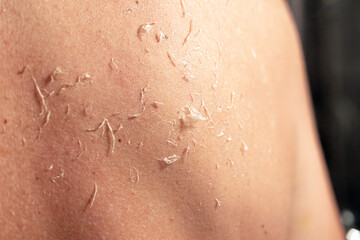 Fototapeta premium Sunburn, close-up of human skin. Peeling skin. Eczema.
