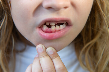 Obraz premium Smiling child with missing teeth. Kid showing tooth gap. Closeup of baby teeth. Child losing milk teeth. Child mouth with new teeth. Kid with toothless smile.