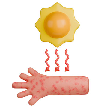 3D medical illustration of severe sunburn. UV rays from the sun cause acute inflammation, redness, and rash on the skin of the arm.