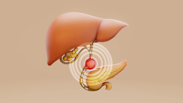Conceptual 3D illustration of a gallbladder stone