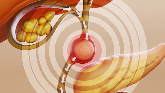 Conceptual 3D illustration of a gallbladder stone