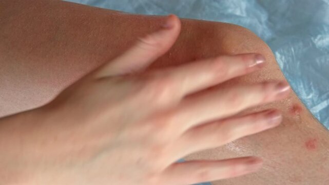 Doctor hands examining leg. Teenage girl allergy. Closeup. Child scratches a red rash. Nurse applies special cream to atopic skin. Dermatitis, diathesis, body irritation. Pruritus. Mosquito, flea bite