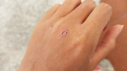 Close up Detailed Wound on Human Hand Skin Surface Body