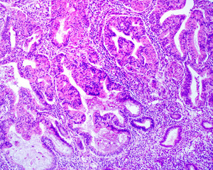 Endometrium. Carcinoma