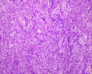 Superior cervical ganglion. Ganglioneuroma