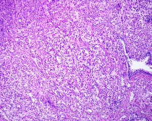 Prostate adenocarcinoma