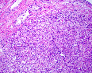 Prostate adenocarcinoma